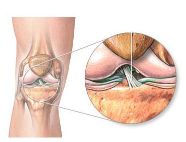 Einfache anatomische Darstellung des vorderen Kreuzbandes